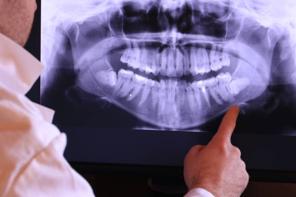 Best Emergency Wisdom Teeth Removal in Kenneth City, FL